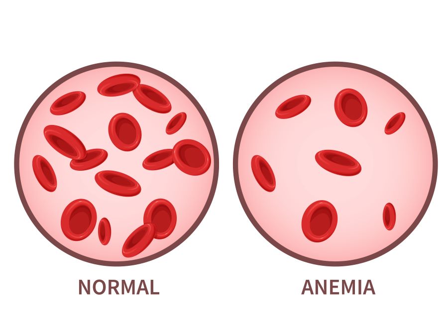 image represent what is anemia