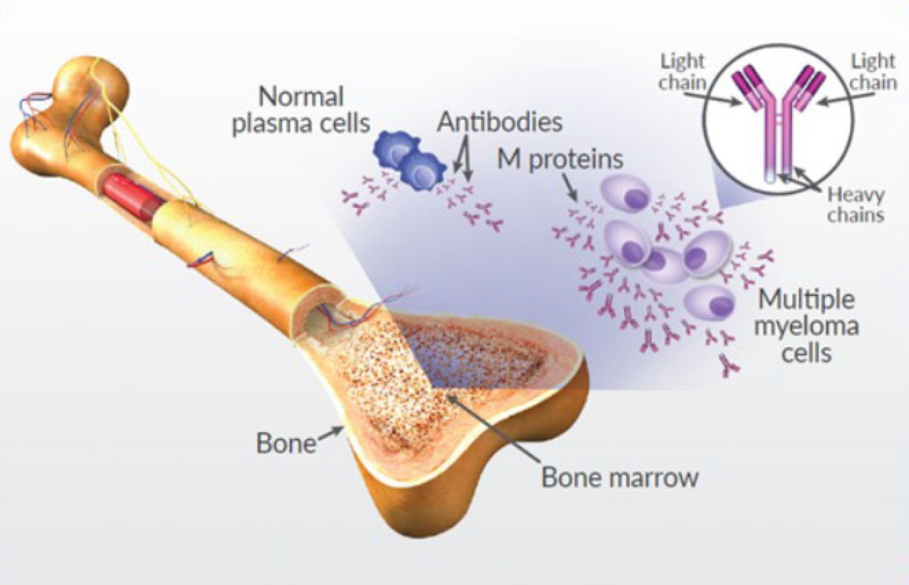  myeloma disease image
